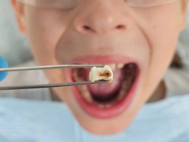 Best Emergency Tooth Extraction in Veedersburg, IN