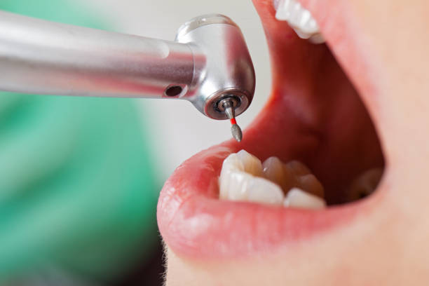 Best Emergency Treatment for Dental Infections or Abscesses in Veedersburg, IN